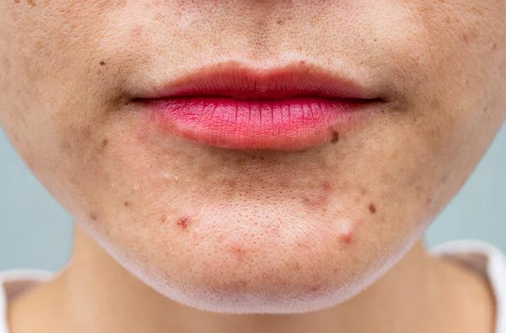 Skin Acne:फेस पर लगातार होने वाले पिंपल्स की सबसे बड़ी वजह है आपका फोन, जाने कैसे?