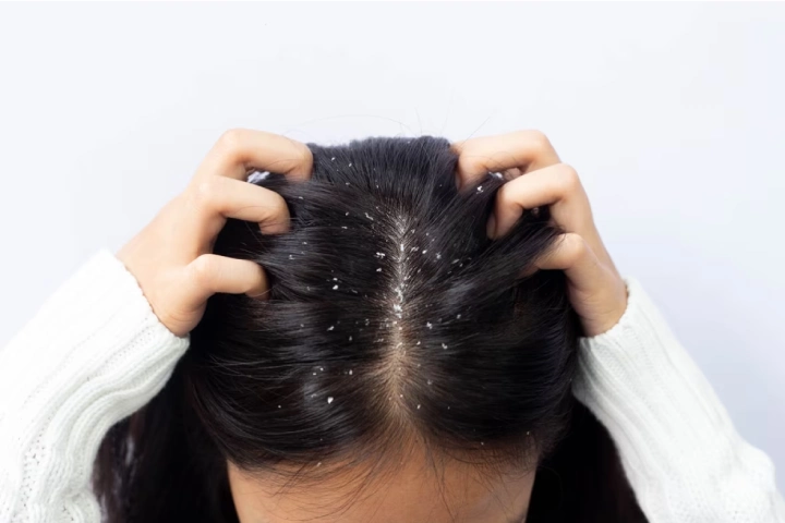 Hair Care: एक हफ्ते के अंदर पूरी तरह गायब हो जाएगा सिर से dandruff, अपना लें यह घरेलू उपाय