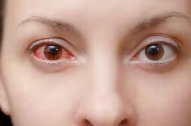 Eye care tips: बारिश के साथ बढ़ा ‘Eye Flu’ का खतरा, यहां जानिए लक्षण और बचाव के उपाय