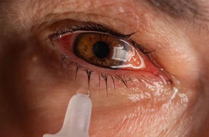 Eye Flu महज 24 घंटे में हो जाएगा ठीक! घर में रखी इन तीन चीजों से धो लें आंखें,  तुरंत मिलेगा आराम