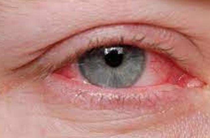 सावधान! EYE FLU में की गई आपकी ये एक गलती छीन सकती है आंखों की रोशनी