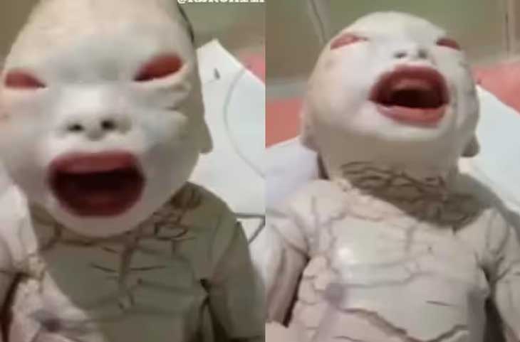 महिला ने दिया ‘एलियन’ जैसे बच्चे को जन्म! डॉक्टर्स भी रह गए हैरान,देखें वीडियो