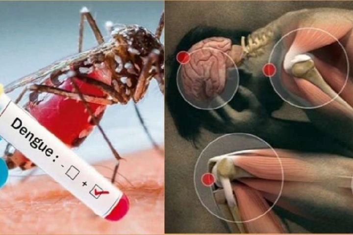 Dengue से रिकवरी के बाद भी लंबे समय तक बनी रह सकती हैं ऐसी समस्याएं, रह-रहकर होता इन अंगों में दर्द