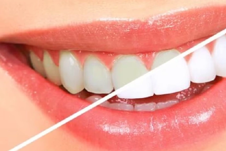Teeth Cleaning: पीले दांतों से अब नहीं होना पड़ेगा परेशान, गंदगी हटाएंगी यह चीजें, मोती जैसी चमकेगी बत्तीसी